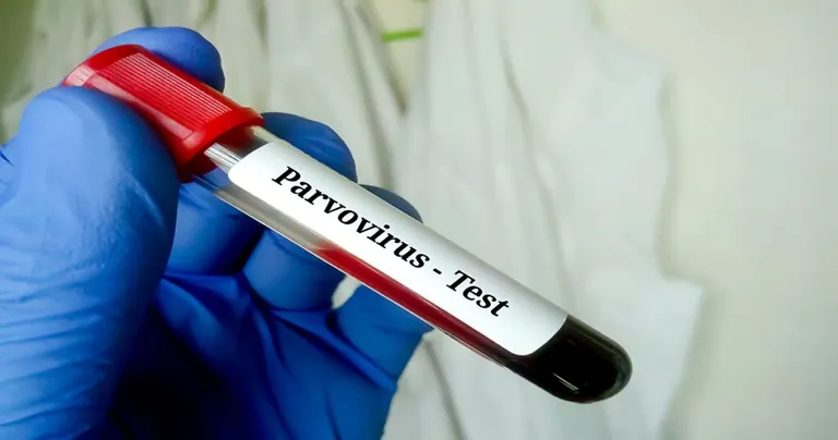 Vijfde ziekte en parvovirus B19 bij zwangerschap